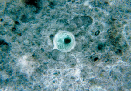 Entamoeba histolytica